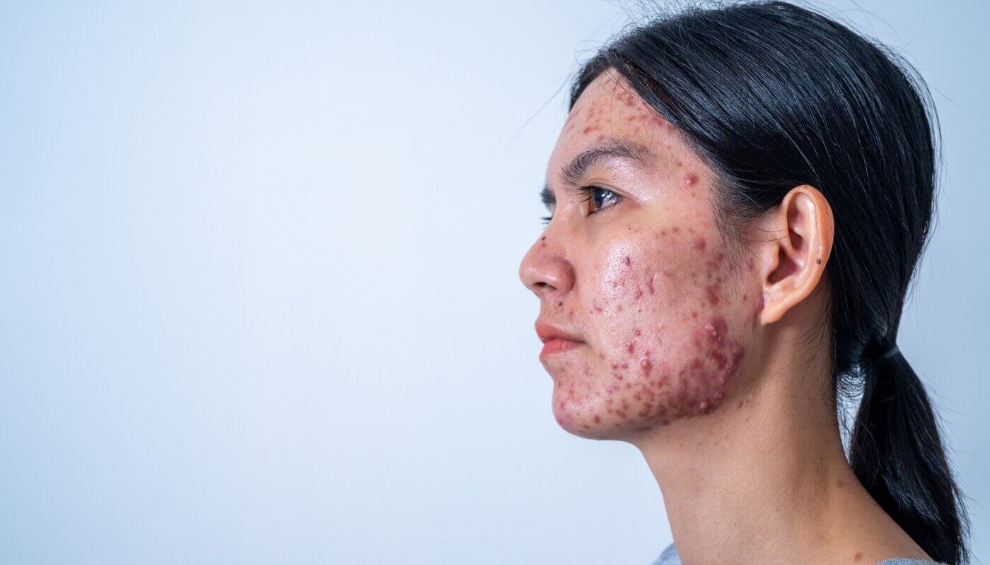 How Can You Treat Sebaceous Hyperplasia? Expert Advice and Home Remedies