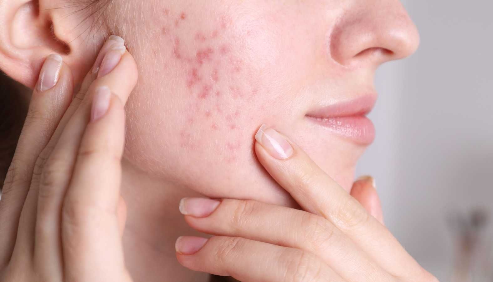 Hormonal Acne: Causes And Natural Treatments